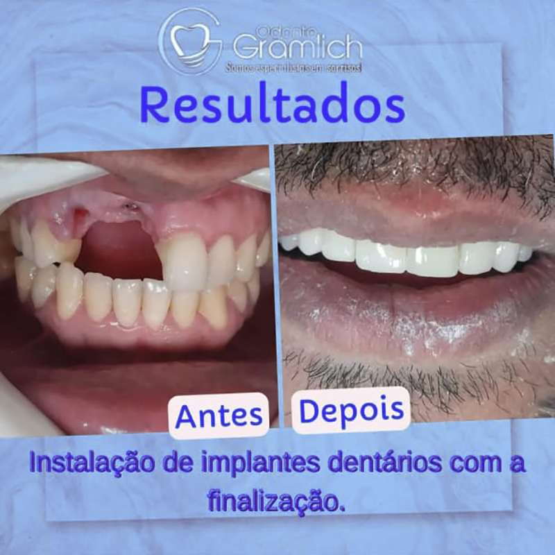 Antes e depois — Instalação de implantes dentários com a finalização