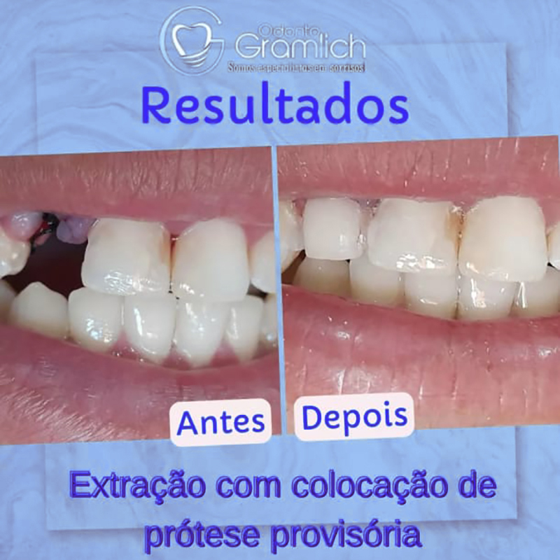 Antes e depois — Extração com colocação de prótese provisória