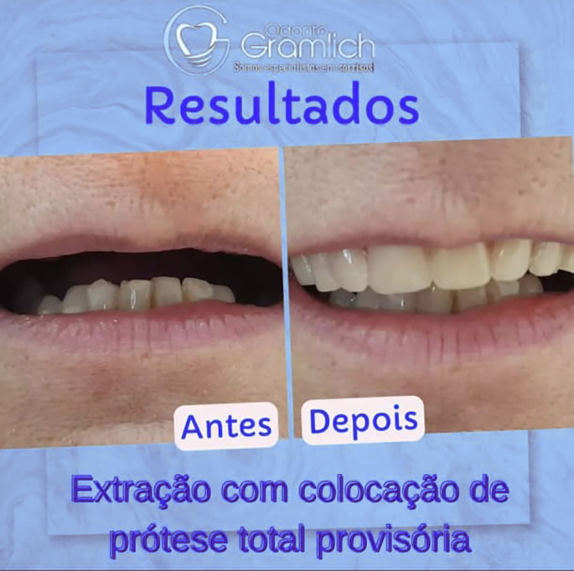 Antes e depois — Extração com colocação de prótese total provisória