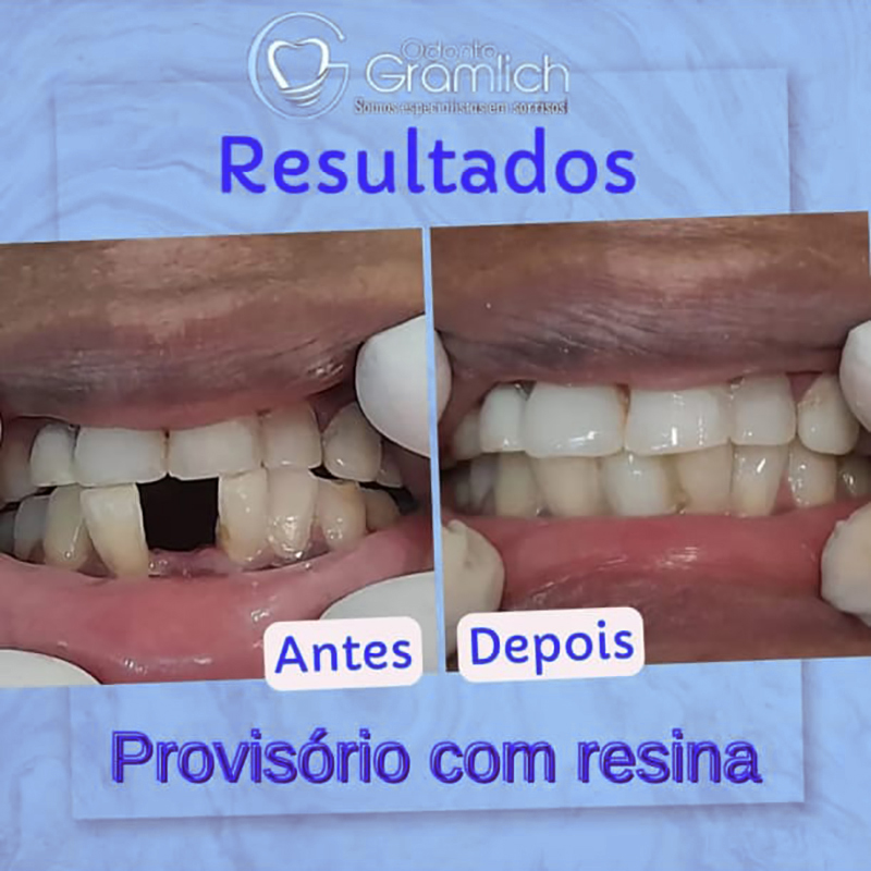 Antes e depois — Provisório com resina